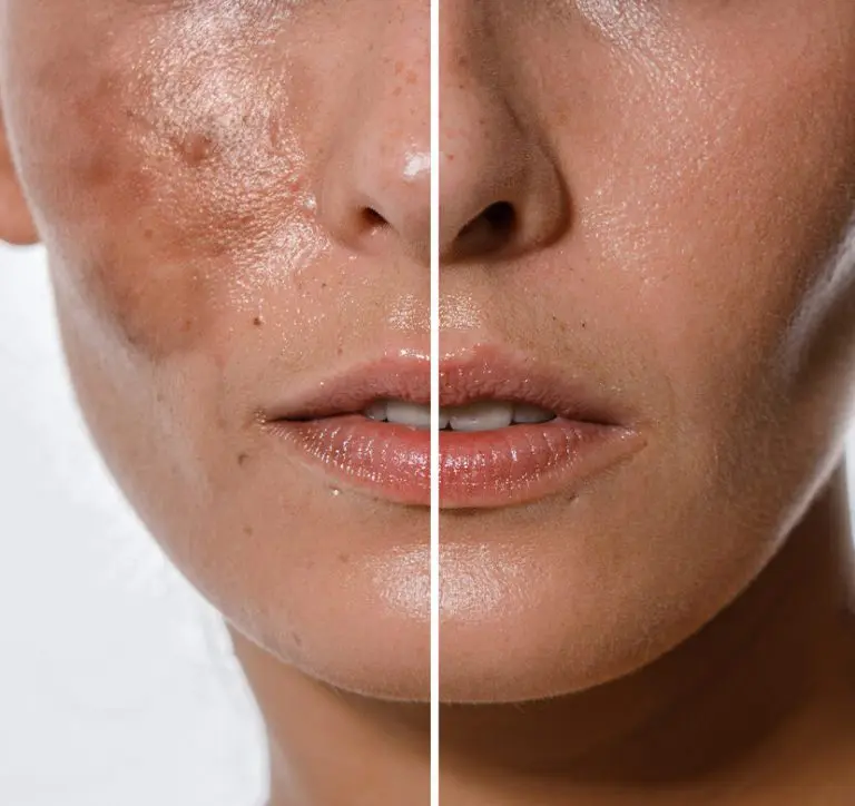 What is hyperpigmentation?