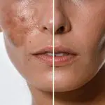 Hyperpigmentation explained