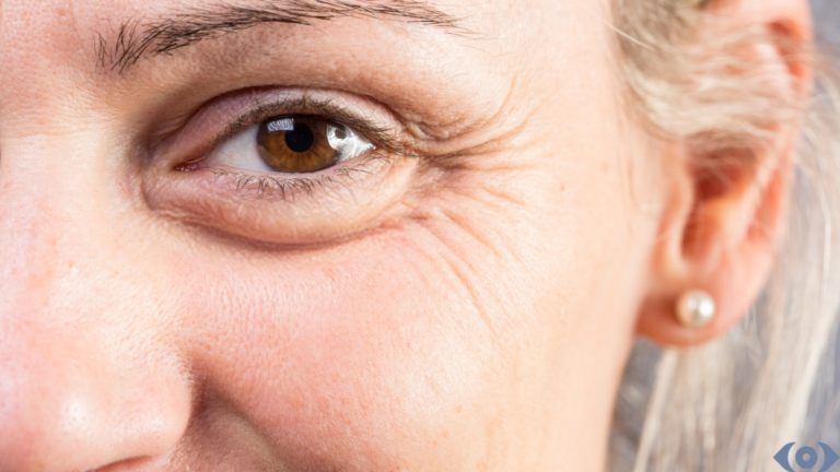 Understanding Fine Lines: Causes, Prevention and   7 Treatments.