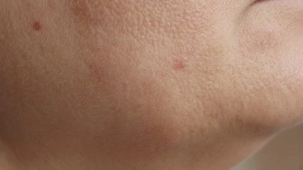 Close-up of a mature woman's cheek and jawline with fine texture, visible pores, and a few small red bumps typical of vitamin c serum breakouts.
