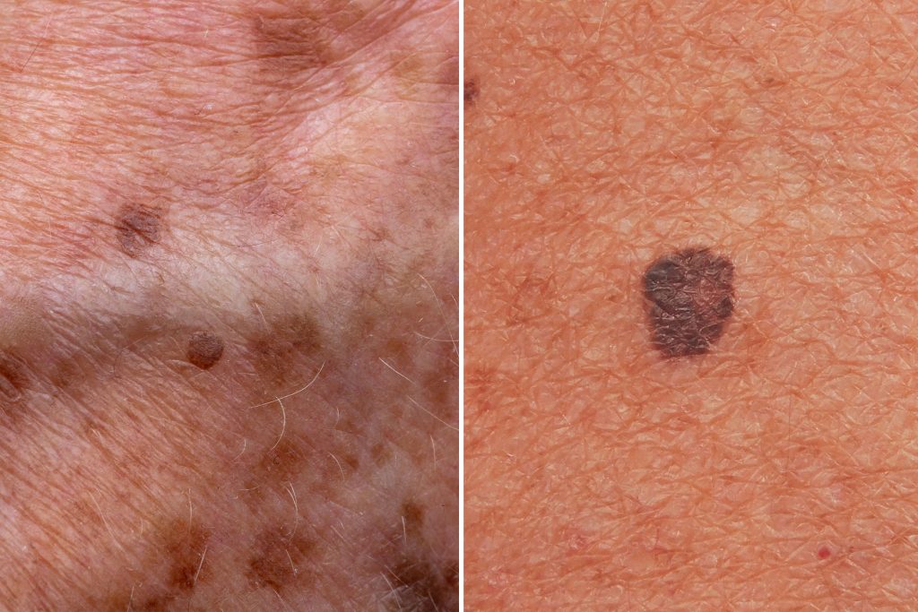 age spots and skin conditions