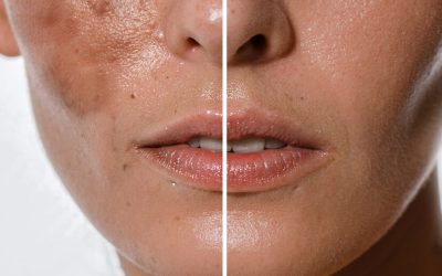 Hyperpigmentation explained