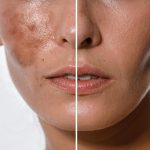 Hyperpigmentation explained