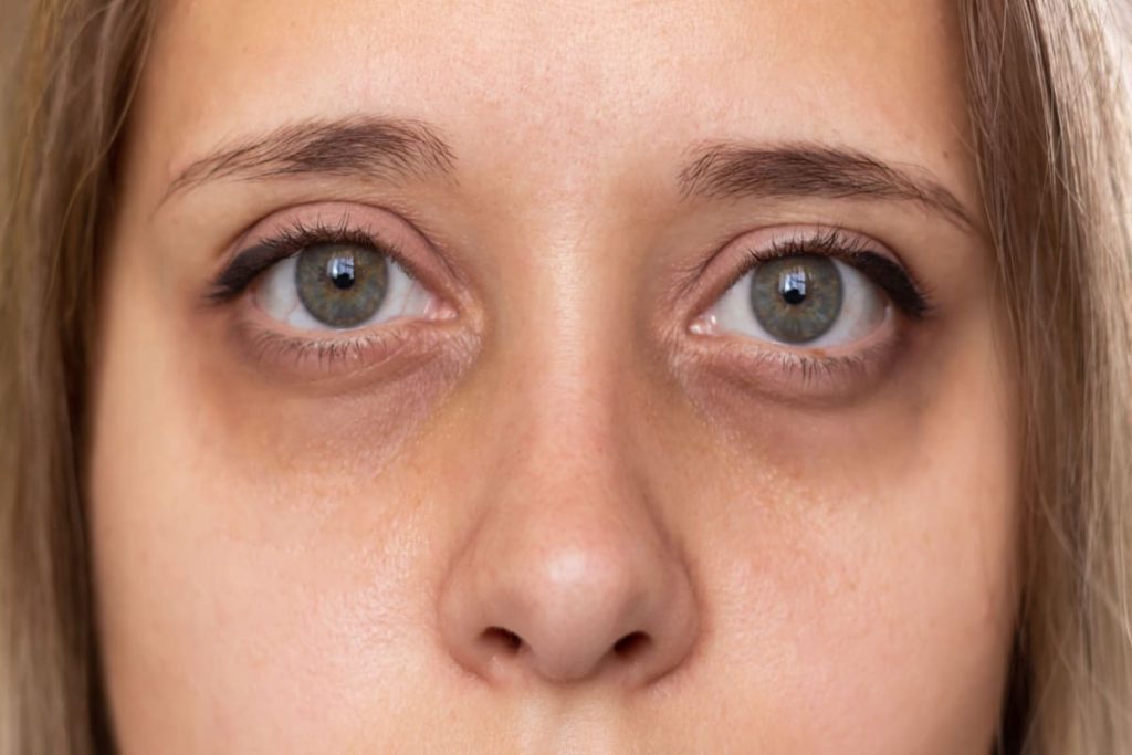 Treatments and causes for Dark Circles