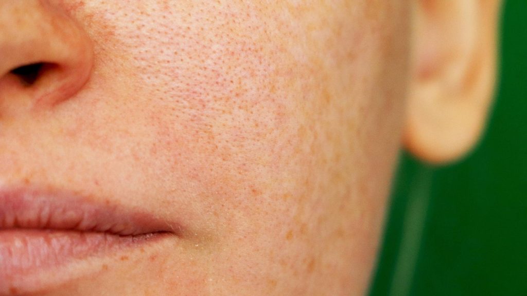 enlarged pores on face