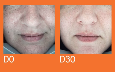 7 Proven Ingredients & Strategies for Clear Skin Dark Spot remover for face. 11 dark spot remover