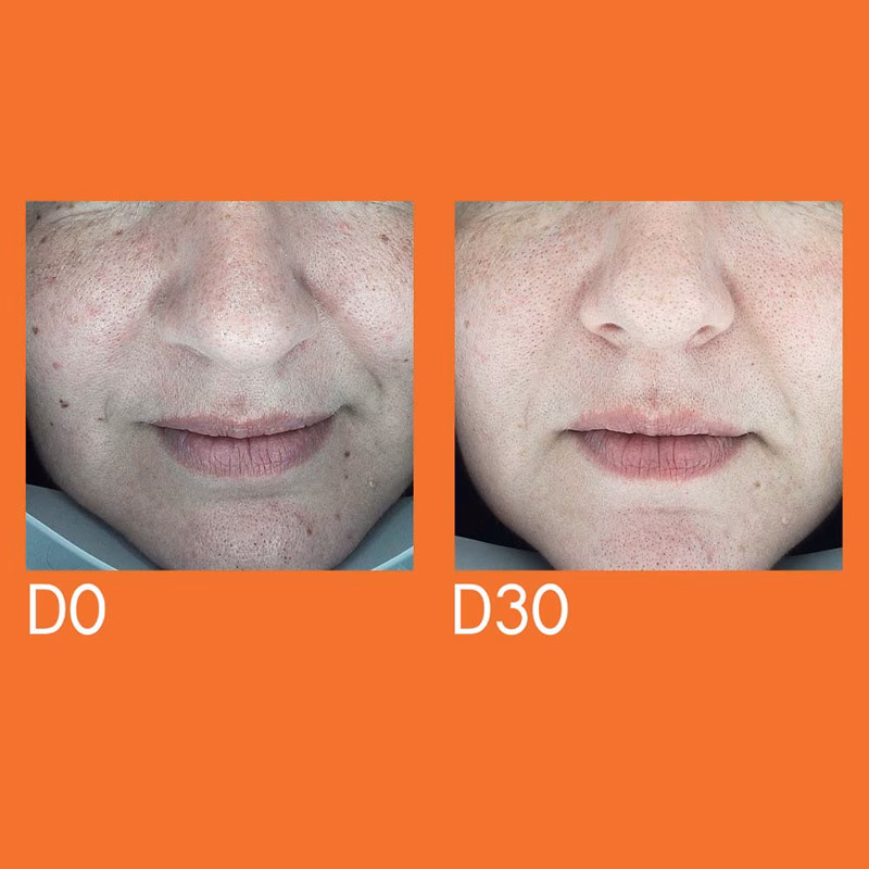 7 Proven Ingredients & Strategies for Clear Skin Dark Spot remover for face. 4 Dark spot remover for face